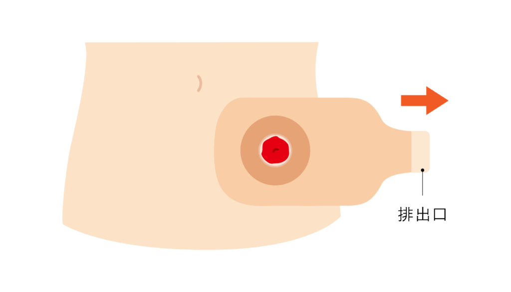 手術後に覚えておきたい | ホリスターブログ